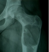 Unicameral Bone Cyst